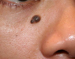 Before mole removal on face