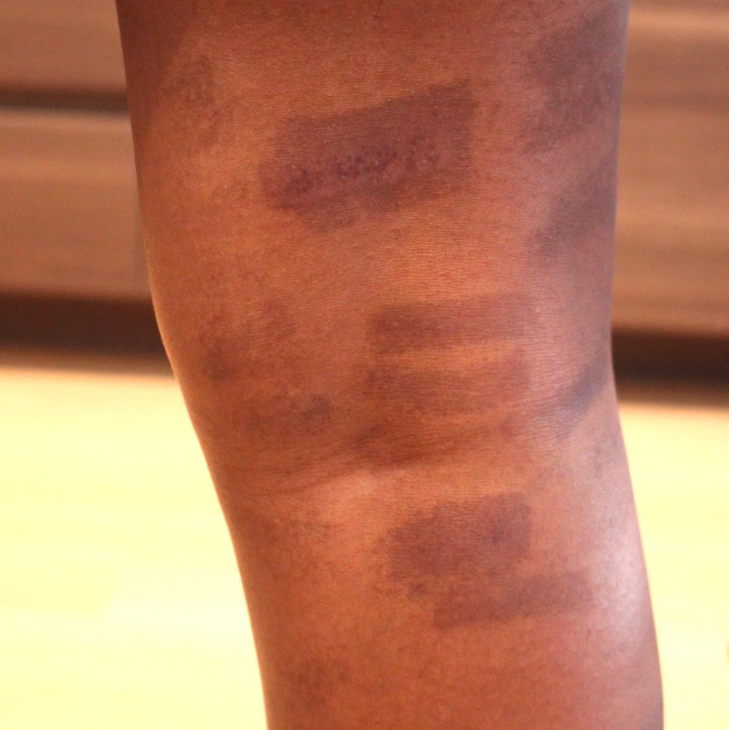 post-inflammatory pigmentation following laser hair removal
