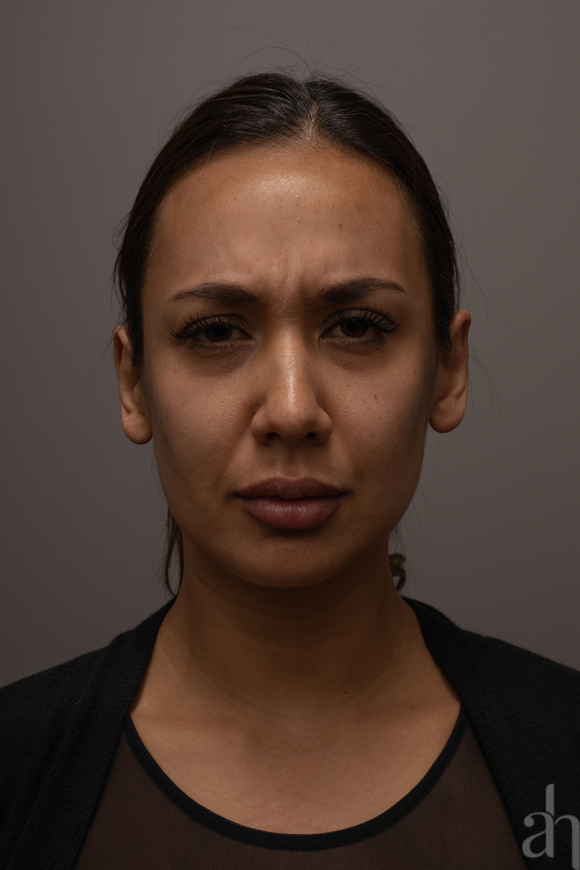 clinical photography - 2d clinical imaging - photo 07 - front 002 - serious face look